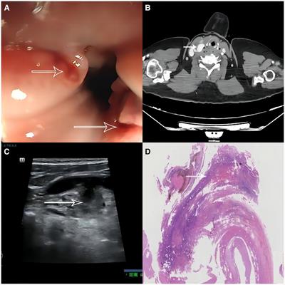 Management strategy of a carotid-esophageal fistula with a right common carotid artery pseudoaneurysm due to chicken bone ingestion: A case report and literature review
